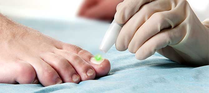 Der Laserstrahl wird während der Behandlung langsam über den Fußnagel geführt