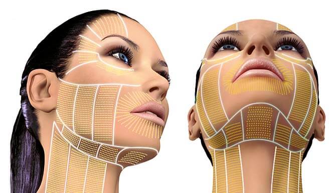 Ultherapy: Typische Areale der Behandlung im Gesicht und am Hals