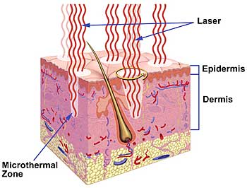 Querschnitt der Haut bei der Behandlung mit einem Fraxel-Laser