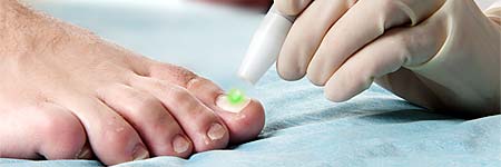 Laserstrahl wird während der Behandlung über den Fußnagel geführt