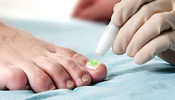 Laserstrahl wird während der Behandlung über den Fußnagel geführt